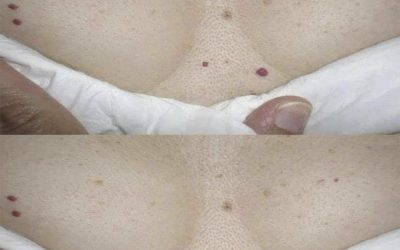 ¿Te han salido puntos rojos en la piel? Esto es lo que tu cuerpo podría estar intentando decirte