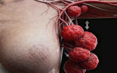 Estos son los síntomas que puedes padecer si tienes cáncer de mama