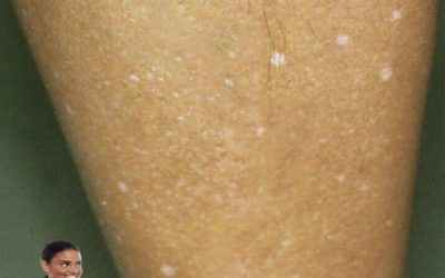 ¿Qué hay detrás de esas manchas blancas en tu piel?