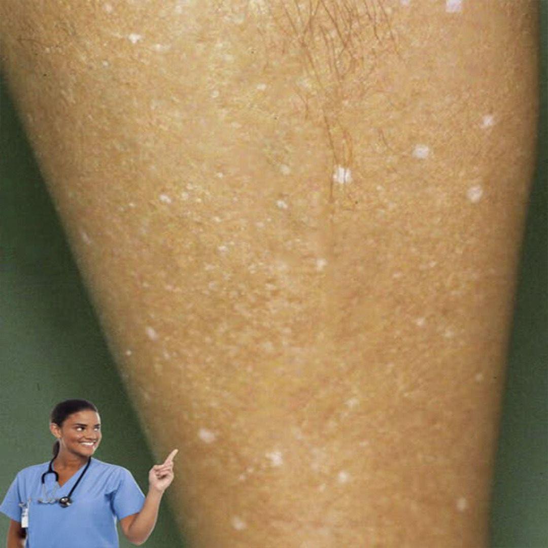 ¿Qué hay detrás de esas manchas blancas en tu piel?