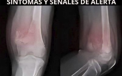 Cáncer de Huesos