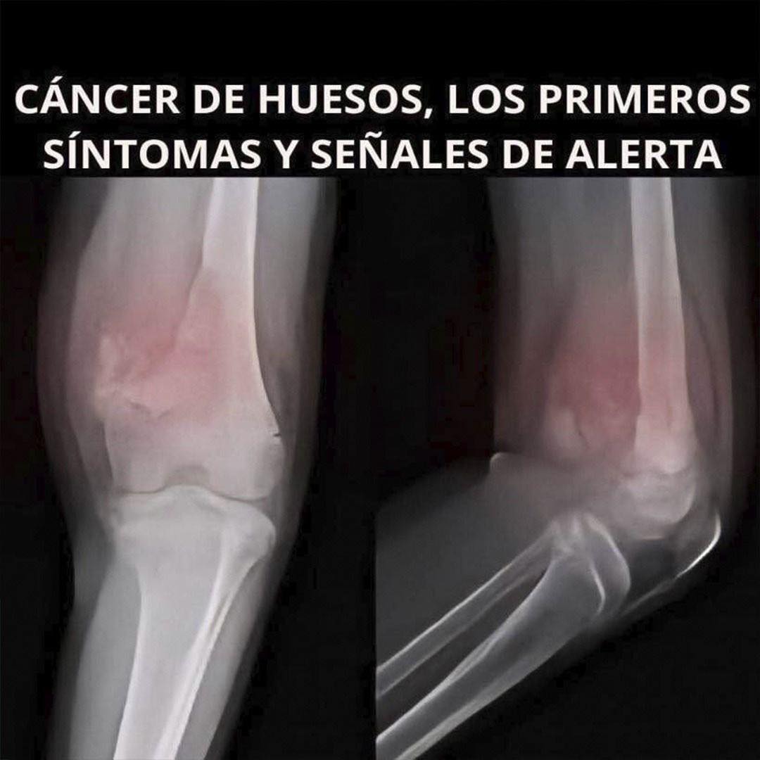 Cáncer de Huesos