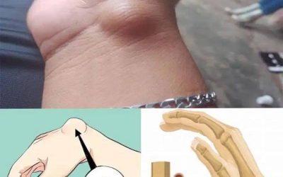 Quistes en la Muñeca: Conoce sus Causas, Síntomas y Remedios Naturales