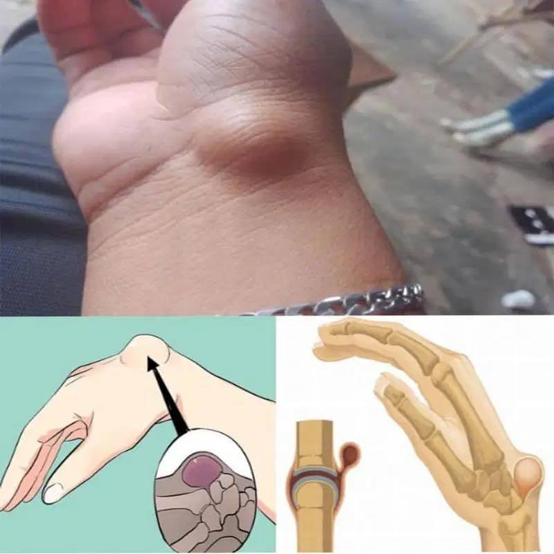 Quistes en la Muñeca: Conoce sus Causas, Síntomas y Remedios Naturales