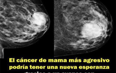 El cáncer de mama más agresivo podría tener una nueva esperanza gracias a un avance con biomarcadores.