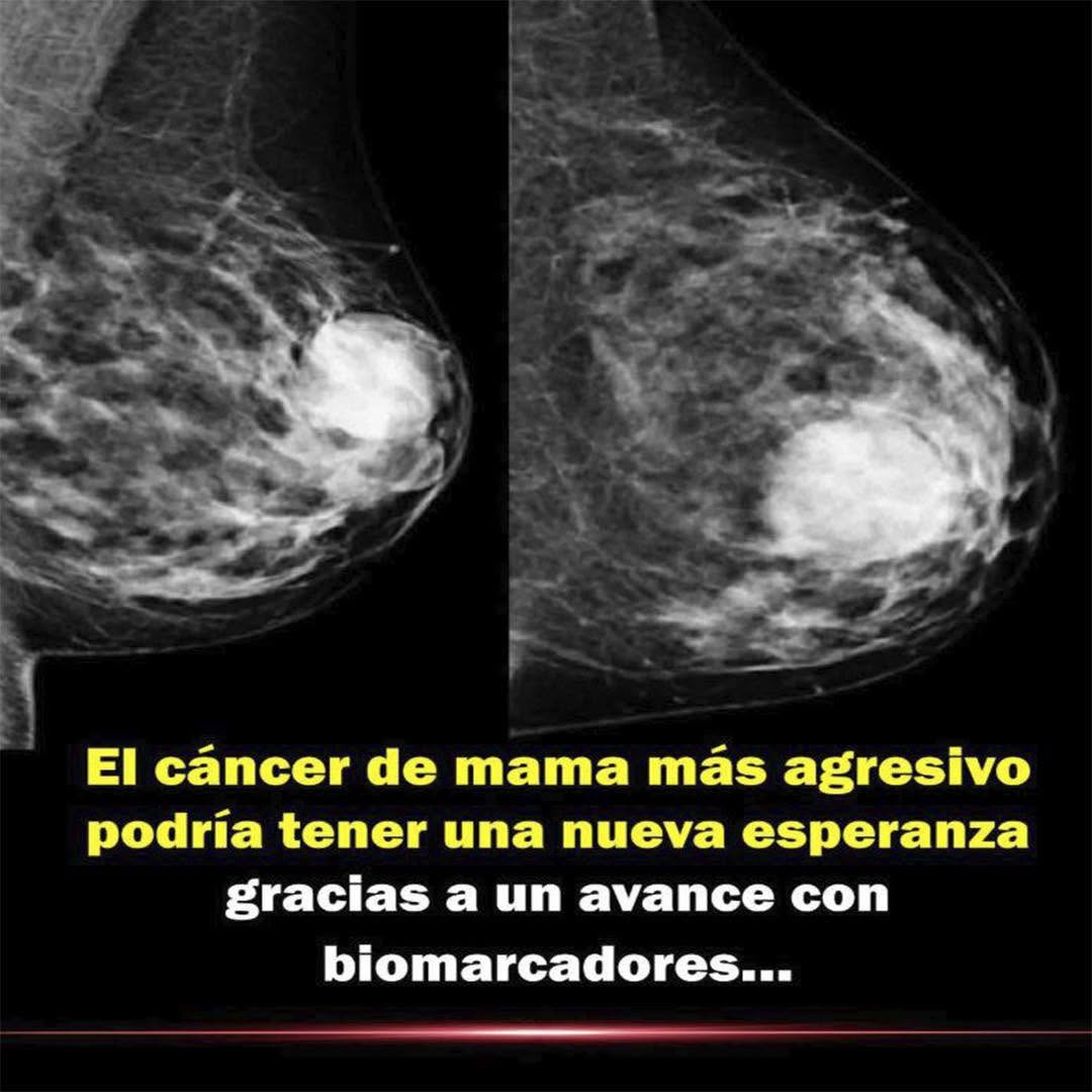 El cáncer de mama más agresivo podría tener una nueva esperanza gracias a un avance con biomarcadores.