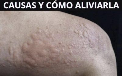 Tipos de erupciones en la piel