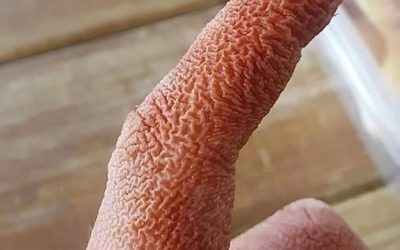 Se revela un impactante misterio médico: unas repentinas y dolorosas lesiones en el rostro de una mujer llevaron a un diagnóstico insólito que dejó atónitos a los médicos.