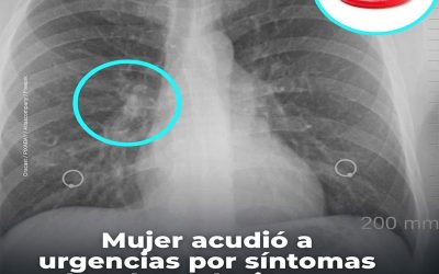 Mujer acudió a urgencias por síntomas de tuberculosis, pero resulto ser un condón