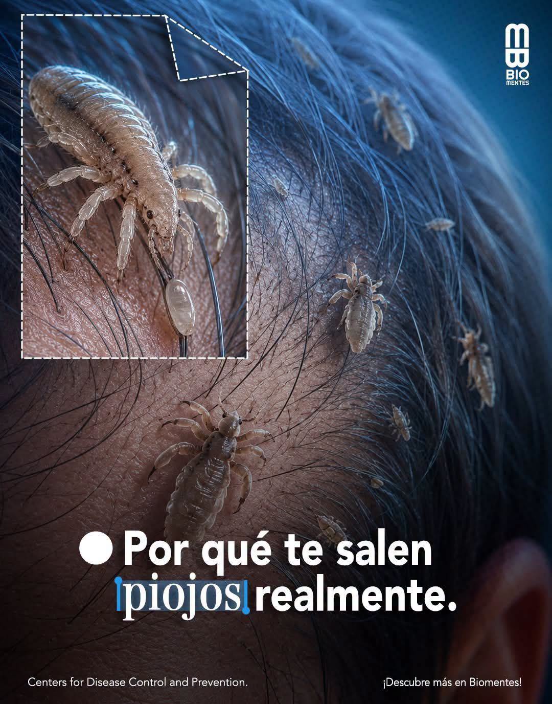 Piojos en los niños