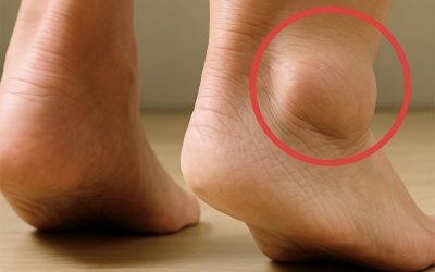 piernas-hinchadas-cuales-son-los-sintomas-y-tratamientos