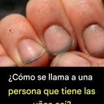 ¿Cómo se llama a una persona que tiene las uñas así?