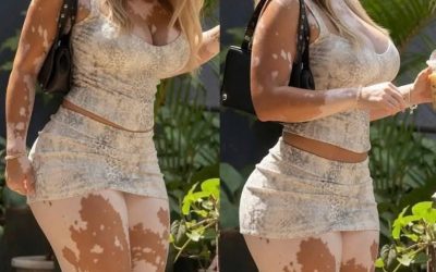 ¿TÚ QUÉ DICES? La rechazan por su vitiligo hasta que les cuenta los hac… Ver más.