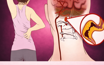 10 señales de alerta temprana de un derrame cerebral que todos deberían conocer para actuar con prontitud.