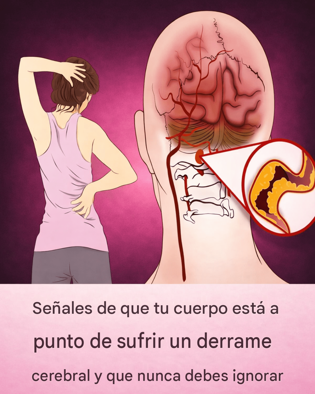 10 señales de alerta temprana de un derrame cerebral que todos deberían conocer para actuar con prontitud.