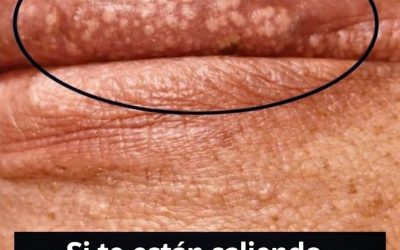 Si te salen granitos blancos en los labios o en la zona íntima, puede deberse a…