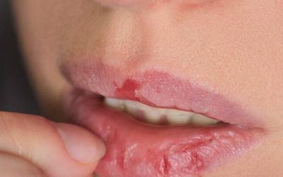 MUCHA ATENCIÓN: Si te sale en tu boca, podrías estar contagiado de…Ver más