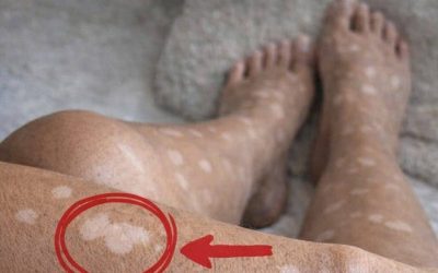 ¿Por qué aparecen manchas blancas en las uñas?