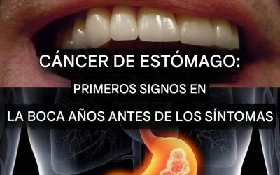 Cáncer de estómago: Primeros signos en la boca años antes de los síntomas (1/2)