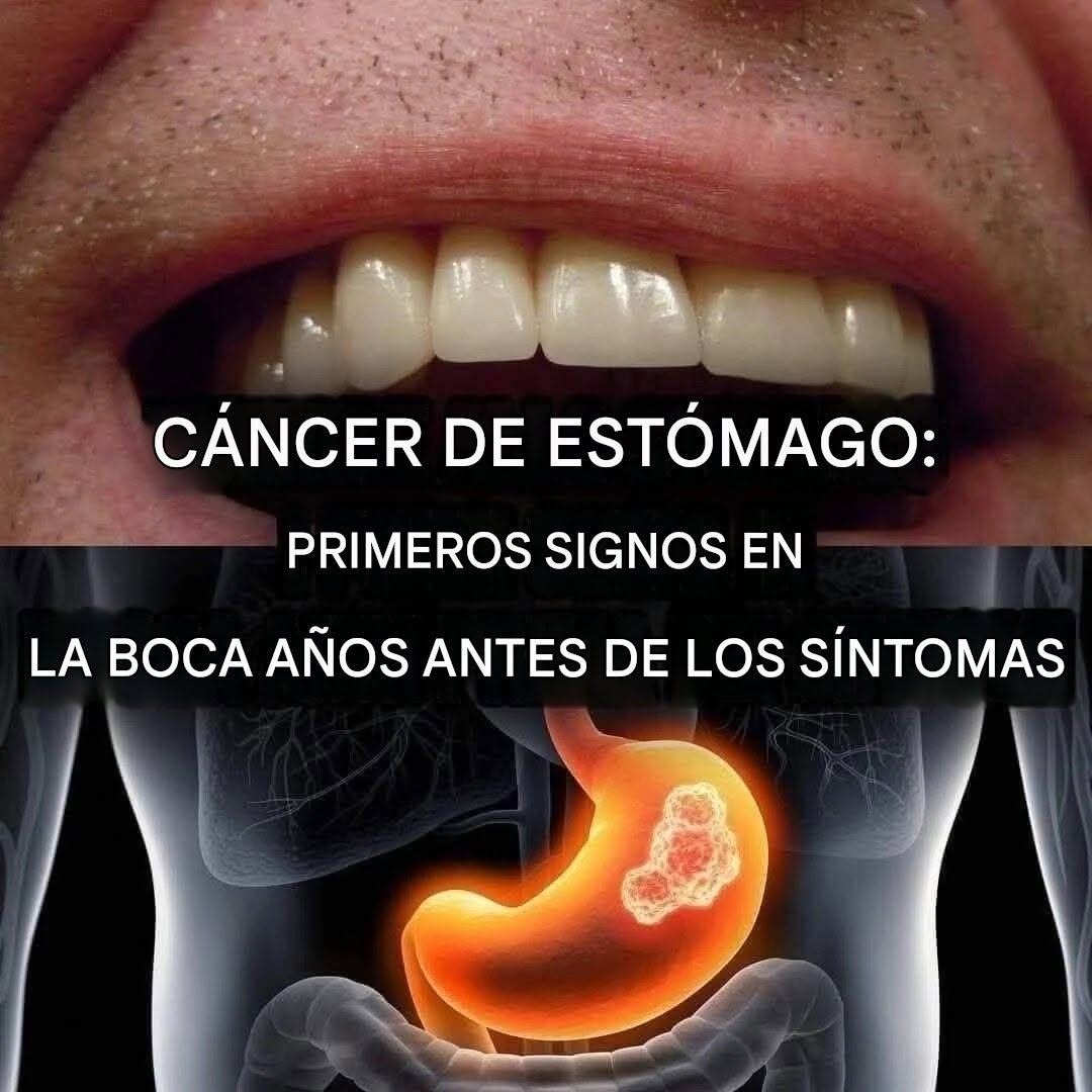 Cáncer de estómago: Primeros signos en la boca años antes de los síntomas (1/2)