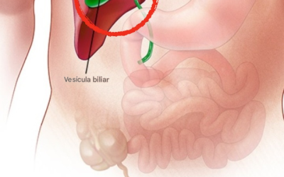 ¿Qué le sucede al cuerpo después de la extirpación de la vesícula biliar? 3 enfermedades que pueden aparecer después: evite la cirugía si es posible.