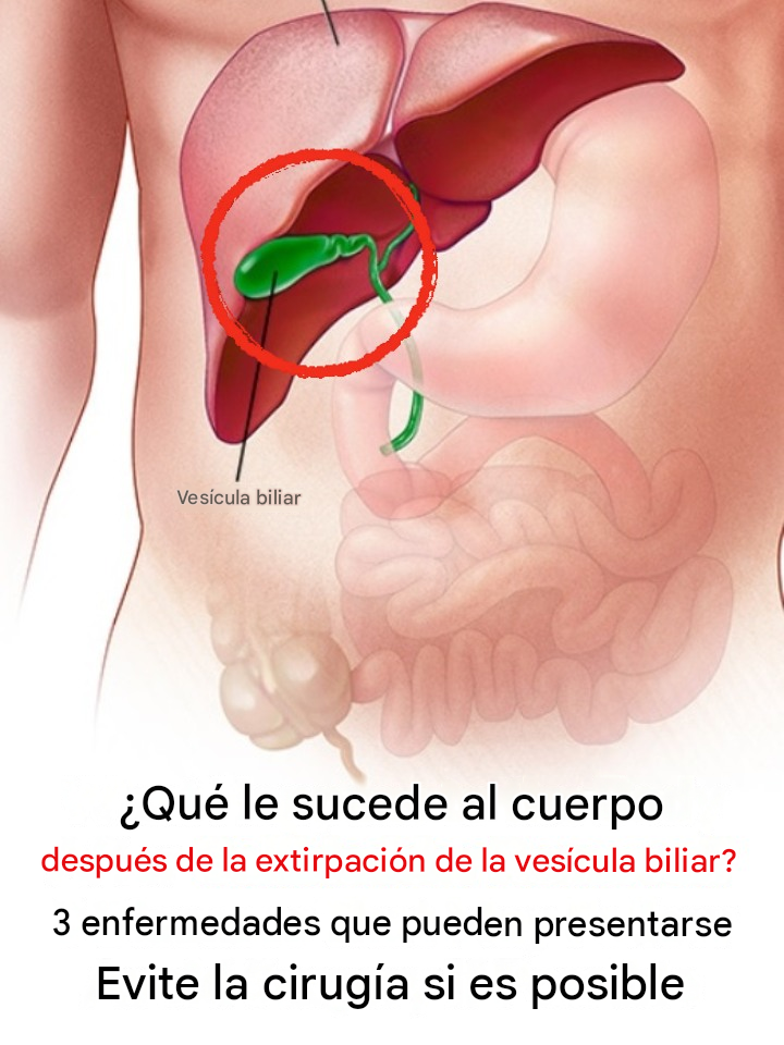 ¿Qué le sucede al cuerpo después de la extirpación de la vesícula biliar? 3 enfermedades que pueden aparecer después: evite la cirugía si es posible.