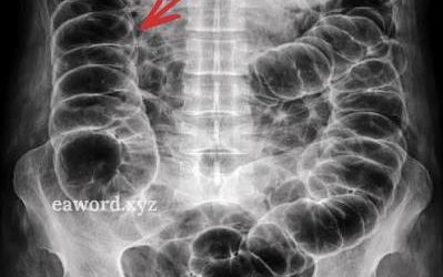 Tienes muchos gases y nadie te lo explica bien… Ver más