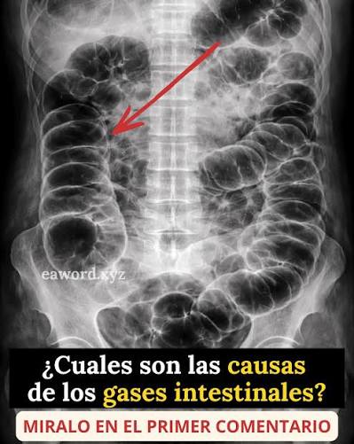 Tienes muchos gases y nadie te lo explica bien… Ver más
