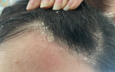 ¿Caspa con mal olor en la cabeza? Lo que realmente indica…