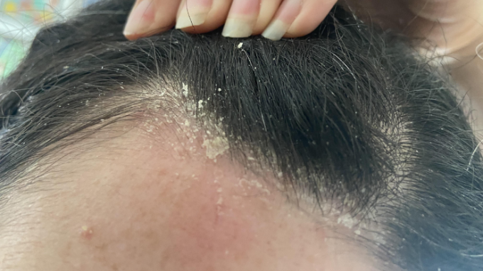 ¿Caspa con mal olor en la cabeza? Lo que realmente indica…